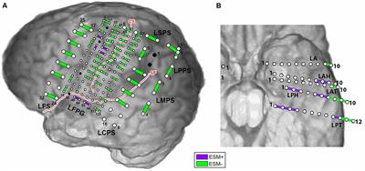 Spatial-Temporal Functional Mapping Combined With Cortico-Cortical Evoked Potentials in Predicting Cortical Stimulation Results